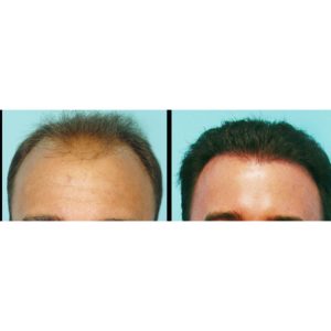 عکس‌های قبل و بعد از کاشت مو