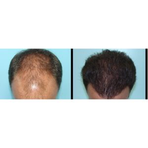 عکس‌های قبل و بعد از کاشت مو